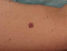 melanoma_2