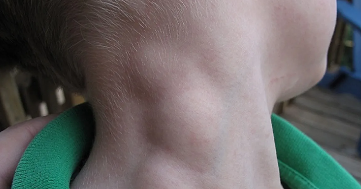 linfoma_1