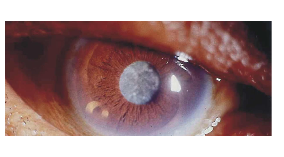 ceguera-por-diabetes