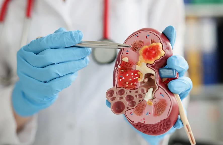 cancer-renal_1