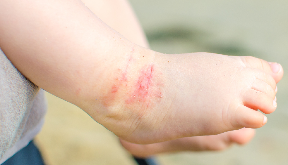 dermatitis-atopica_1
